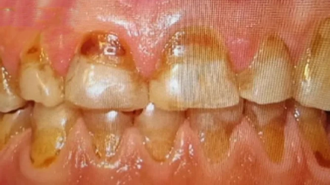 Antes: Rehabilitación Oral