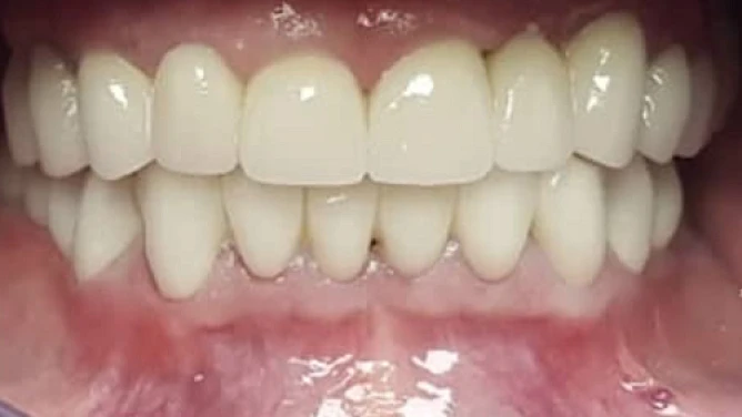 Después: Diseño de Sonrisa