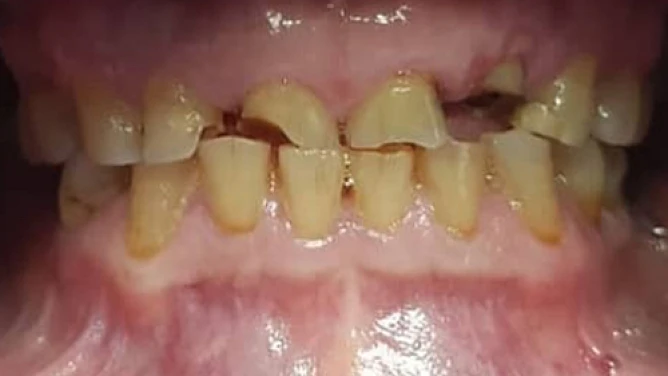 Antes: Diseño de Sonrisa