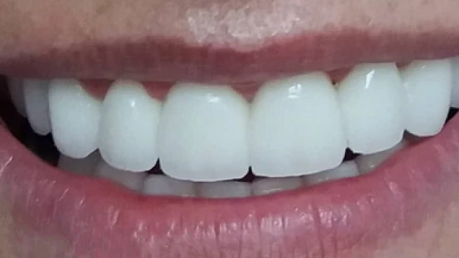 Después: Ortodoncia Invisible