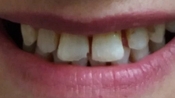 Antes: Ortodoncia Invisible