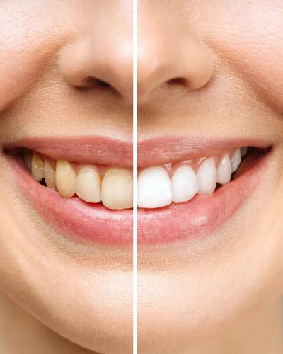 Blanqueamiento Dental Profesional