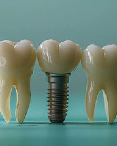 Implantes Dentales