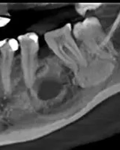 Quistectomías Dentales