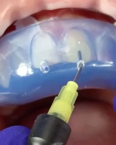 Carillas de Resina Inyectada