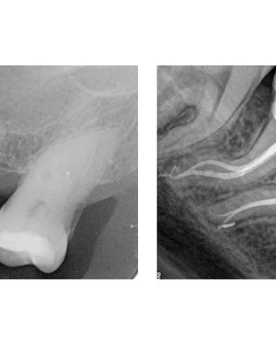 Casos Complejos de Endodoncia