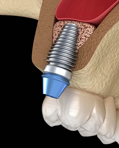 Elevación de Seno Maxilar